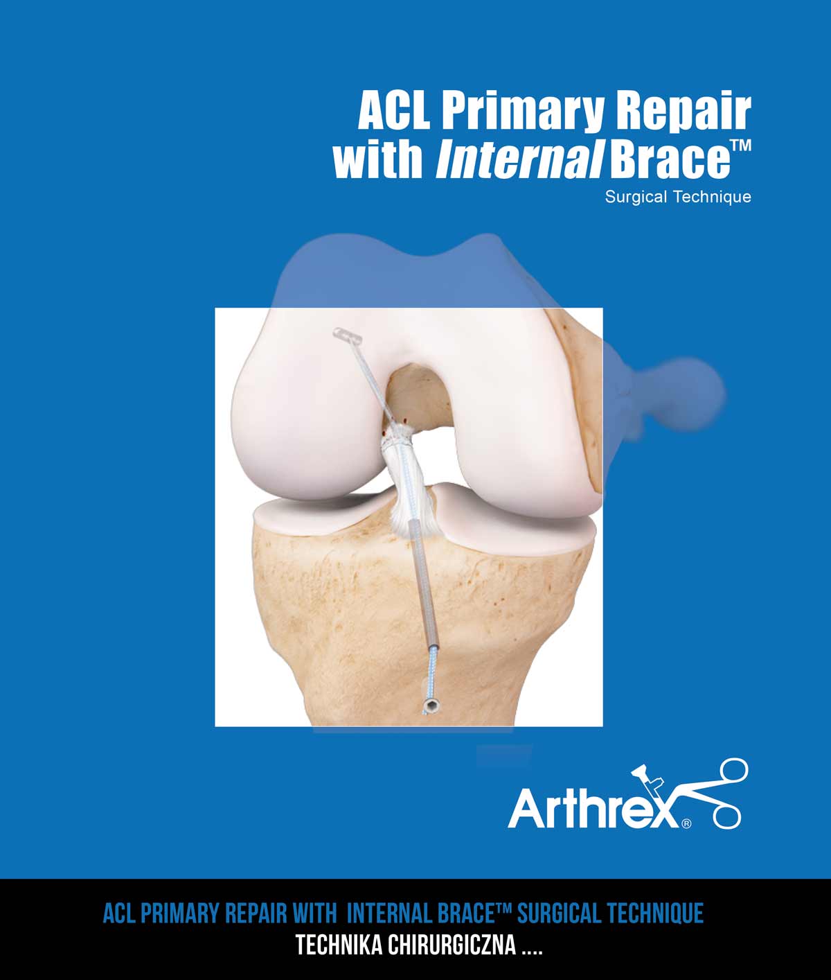ACL Primary Repair with  Internal Brace™ surgical technique 