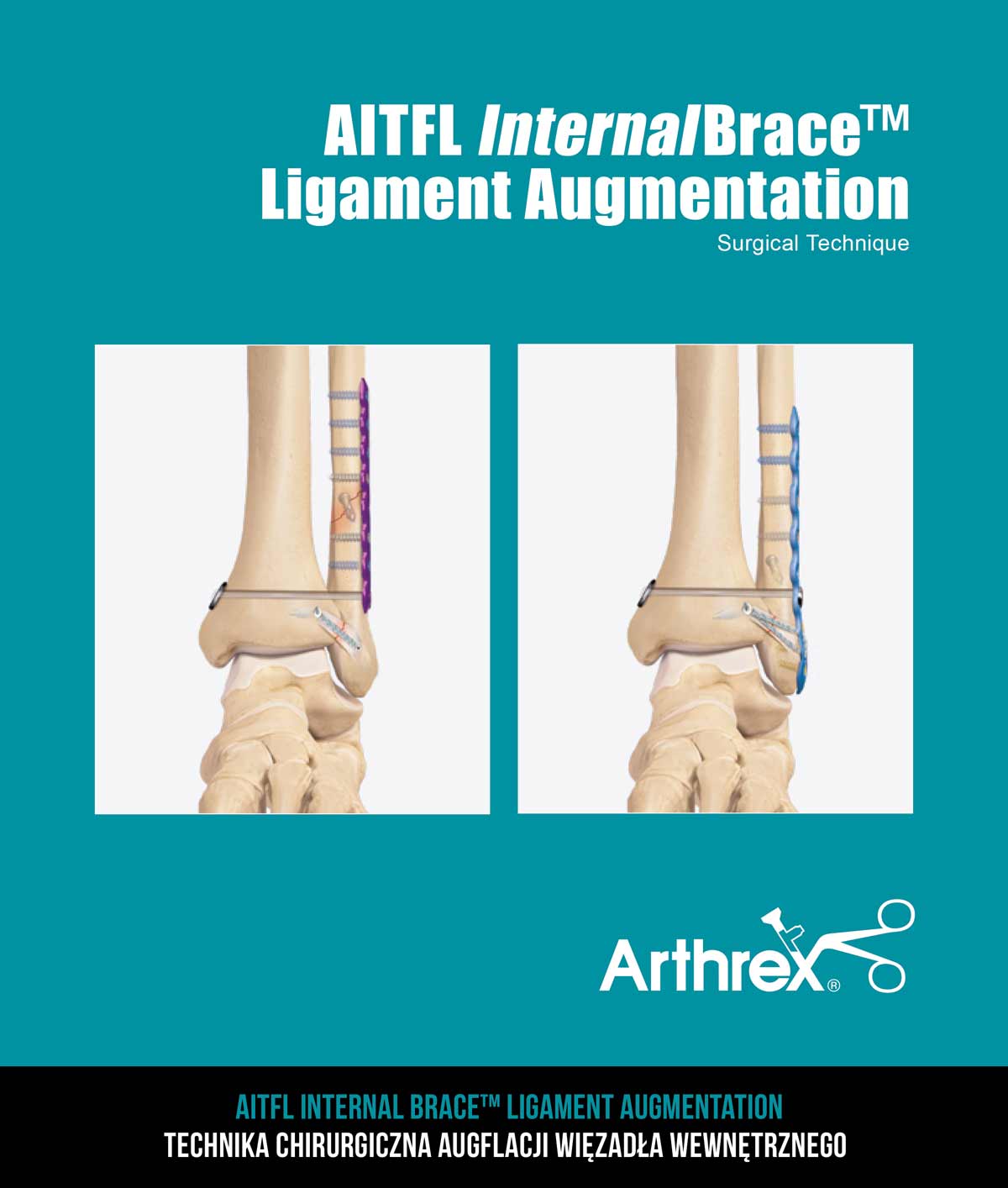 AITFL Internal Brace™ Ligament Augmentation