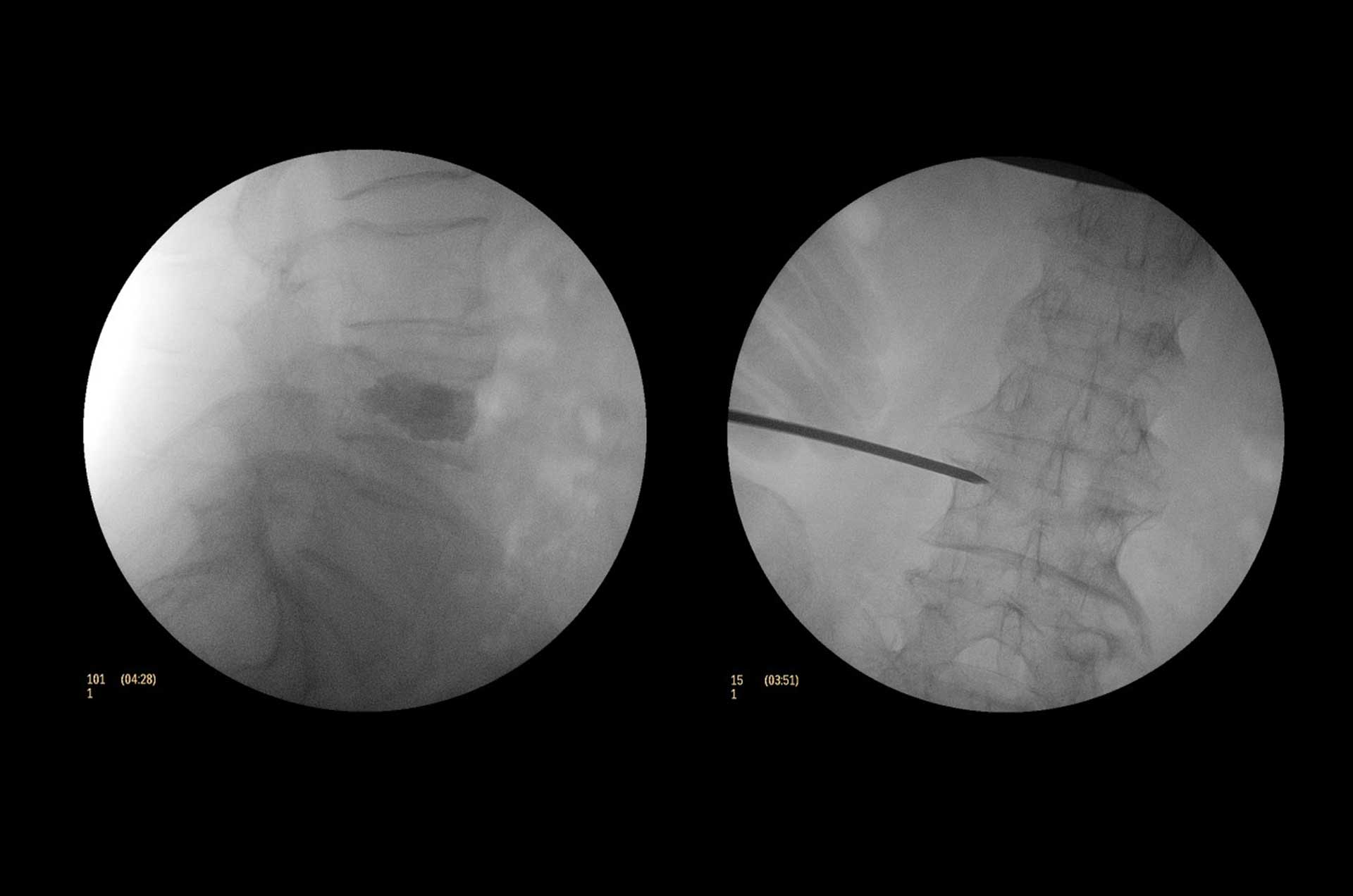 /wertebroplastyka winieta podstrony serwisu CMS w Warszawie